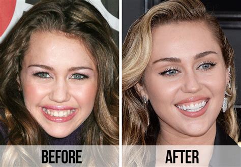 are miley cyrus teeth fake